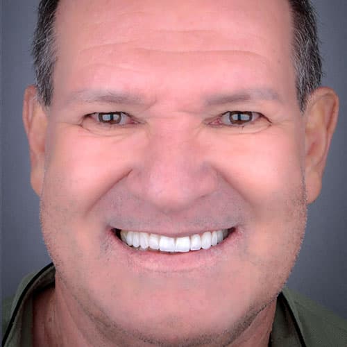 Depois do tratamento